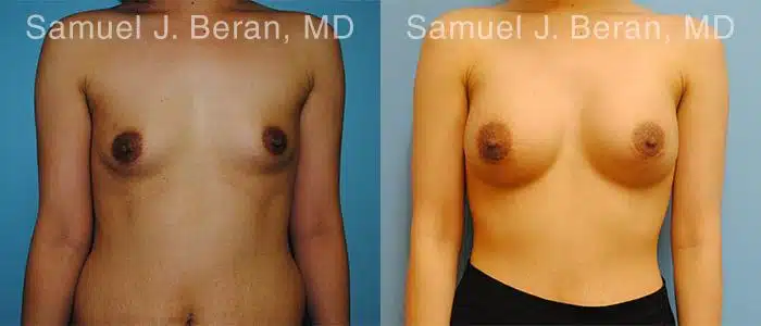 Breast Augmentation Before and After Photos in Newburgh, NY, Patient 12314