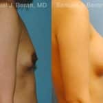 Breast Augmentation Before and After Photos in Newburgh, NY, Patient 12314