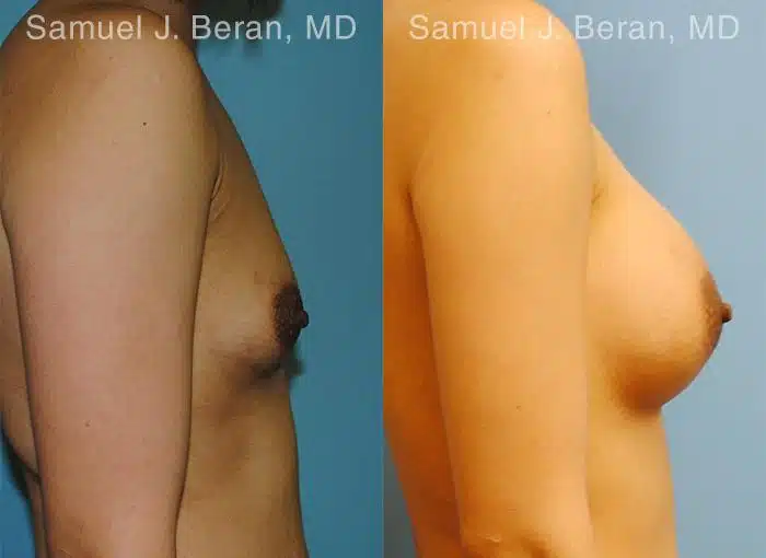 Breast Augmentation Before and After Photos in Newburgh, NY, Patient 12314