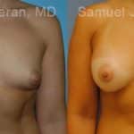 Breast Augmentation Before and After Photos in Newburgh, NY, Patient 12319