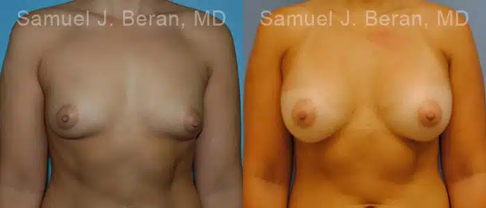 Breast Augmentation Before and After Photos in Newburgh, NY, Patient 12319