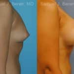 Breast Augmentation Before and After Photos in Newburgh, NY, Patient 12319