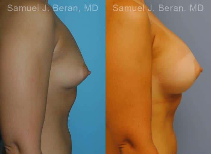 Breast Augmentation Before and After Photos in Newburgh, NY, Patient 12319