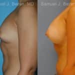 Breast Augmentation Before and After Photos in Newburgh, NY, Patient 12319