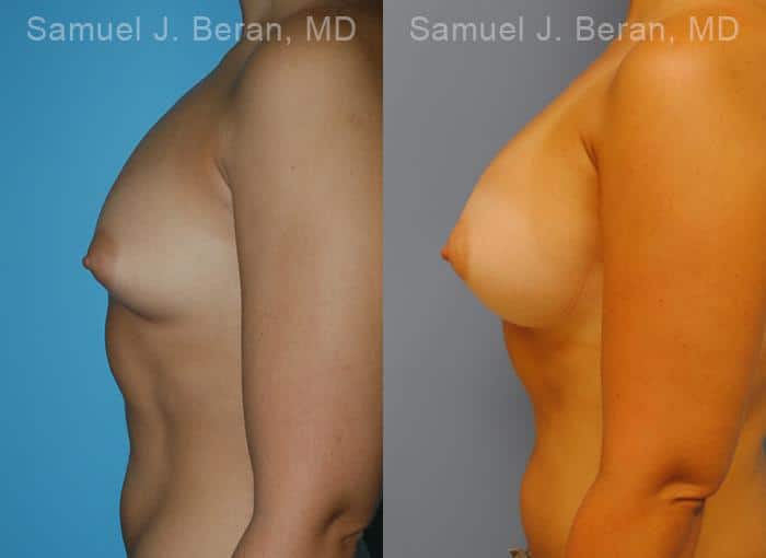 Breast Augmentation Before and After Photos in Newburgh, NY, Patient 12319