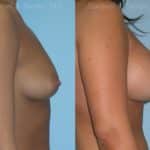 Breast Augmentation Before and After Photos in Newburgh, NY, Patient 12326