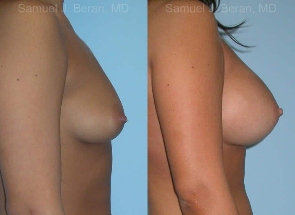 Breast Augmentation Before and After Photos in Newburgh, NY, Patient 12326