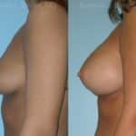 Breast Augmentation Before and After Photos in Newburgh, NY, Patient 12326