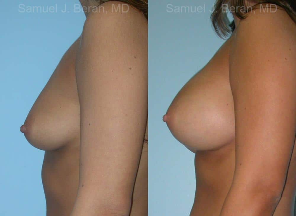 Breast Augmentation Before and After Photos in Newburgh, NY, Patient 12326