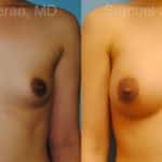 Breast Augmentation Before and After Photos in Newburgh, NY, Patient 12333