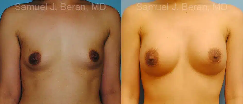 Breast Augmentation Before and After Photos in Newburgh, NY, Patient 12333