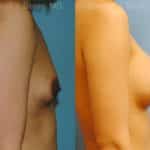 Breast Augmentation Before and After Photos in Newburgh, NY, Patient 12333