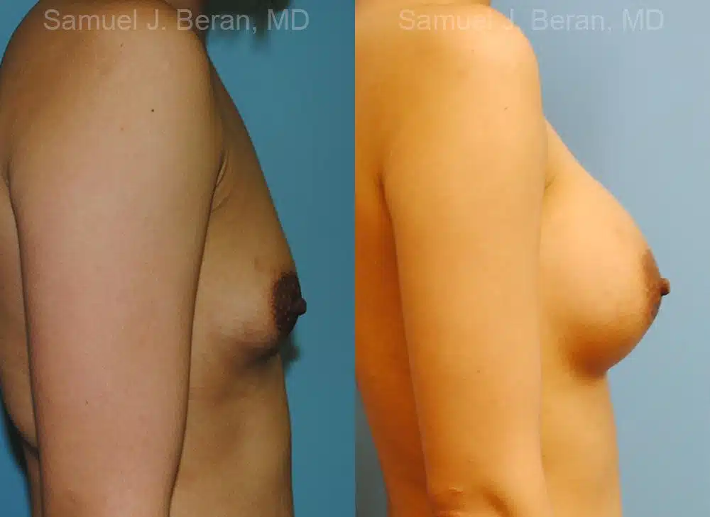 Breast Augmentation Before and After Photos in Newburgh, NY, Patient 12333