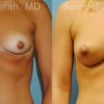 Breast Augmentation Before and After Photos in Newburgh, NY, Patient 12338