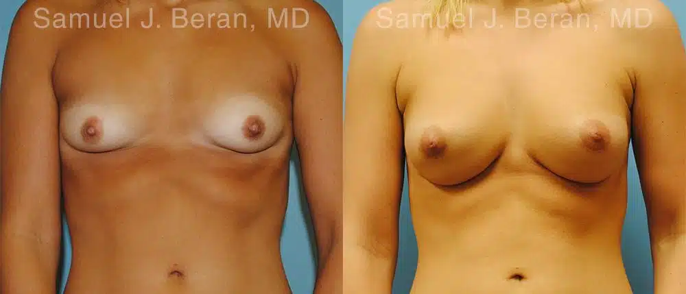 Breast Augmentation Before and After Photos in Newburgh, NY, Patient 12338