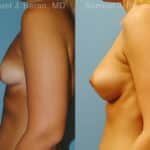 Breast Augmentation Before and After Photos in Newburgh, NY, Patient 12338