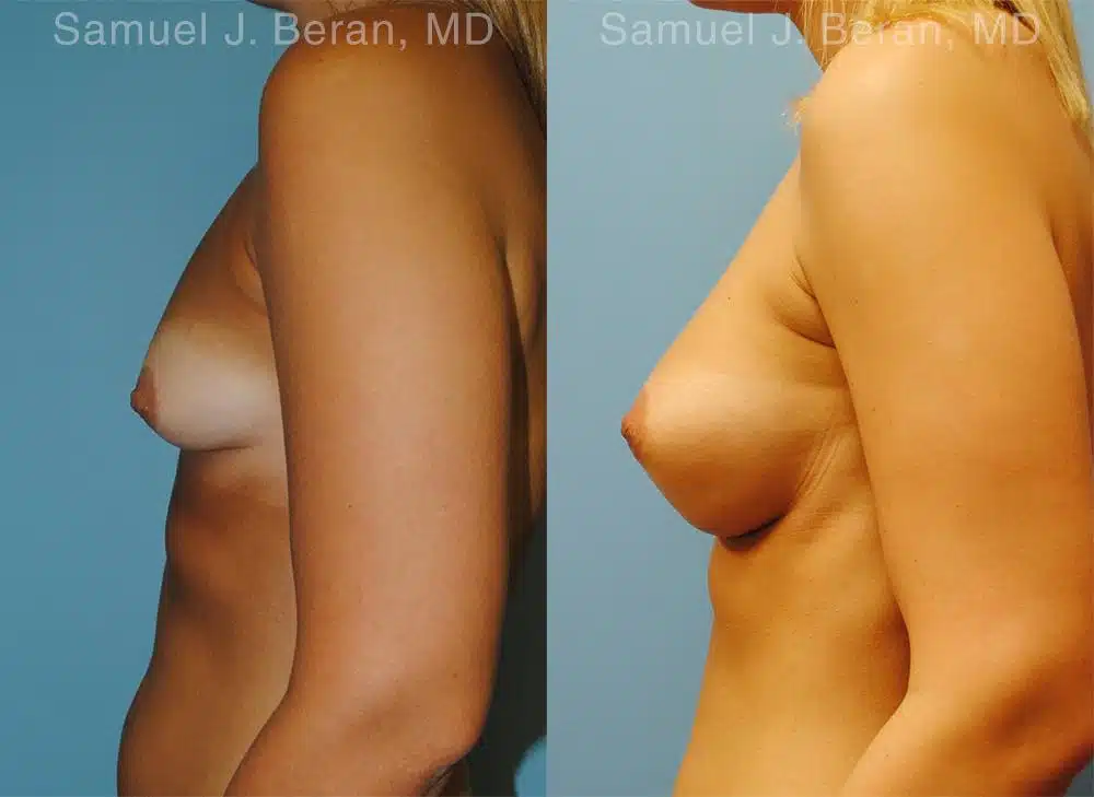 Breast Augmentation Before and After Photos in Newburgh, NY, Patient 12338