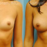 Breast Augmentation Before and After Photos in Newburgh, NY, Patient 12343