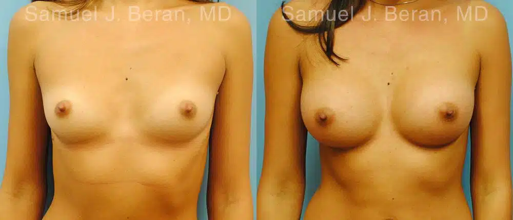 Breast Augmentation Before and After Photos in Newburgh, NY, Patient 12343