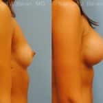 Breast Augmentation Before and After Photos in Newburgh, NY, Patient 12343