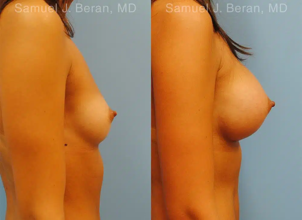 Breast Augmentation Before and After Photos in Newburgh, NY, Patient 12343