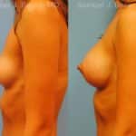 Breast Augmentation Before and After Photos in Newburgh, NY, Patient 12343