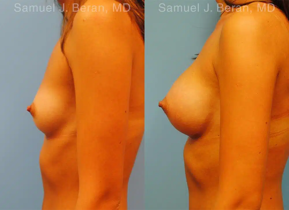 Breast Augmentation Before and After Photos in Newburgh, NY, Patient 12343