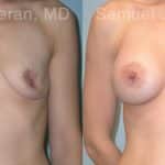 Breast Augmentation Before and After Photos in Newburgh, NY, Patient 12350