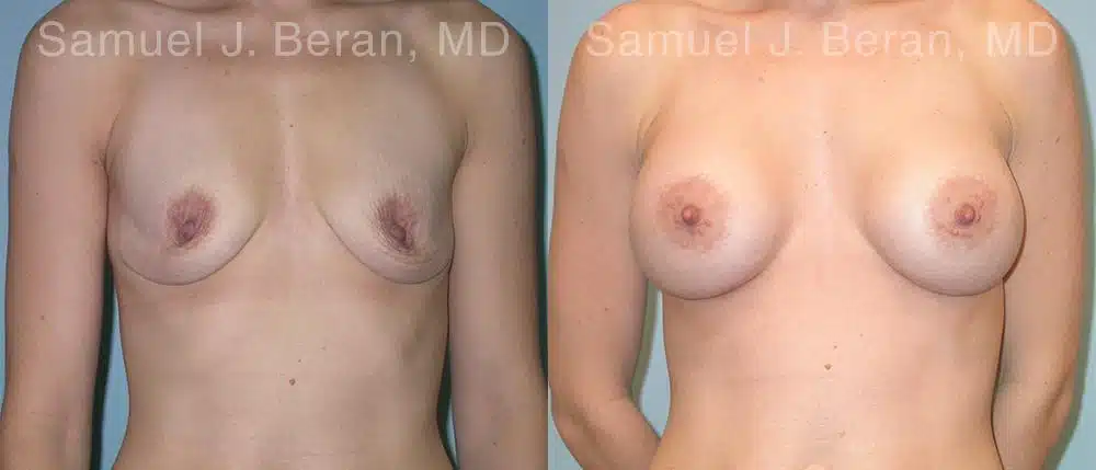 Breast Augmentation Before and After Photos in Newburgh, NY, Patient 12350