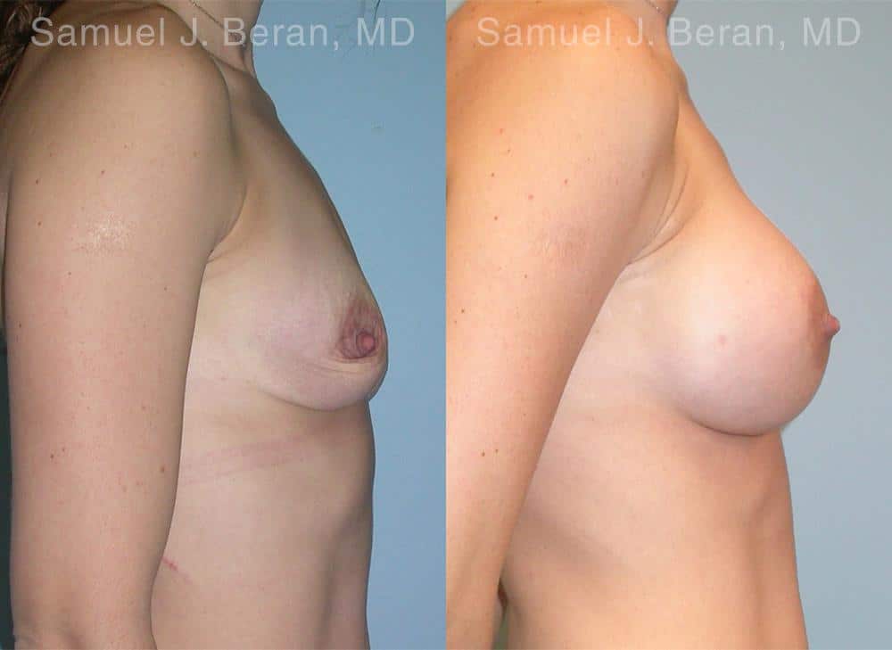 Breast Augmentation Before and After Photos in Newburgh, NY, Patient 12350