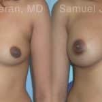 Breast Augmentation Before and After Photos in Newburgh, NY, Patient 12357