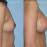 Breast Augmentation Before and After Photos in Newburgh, NY, Patient 12357