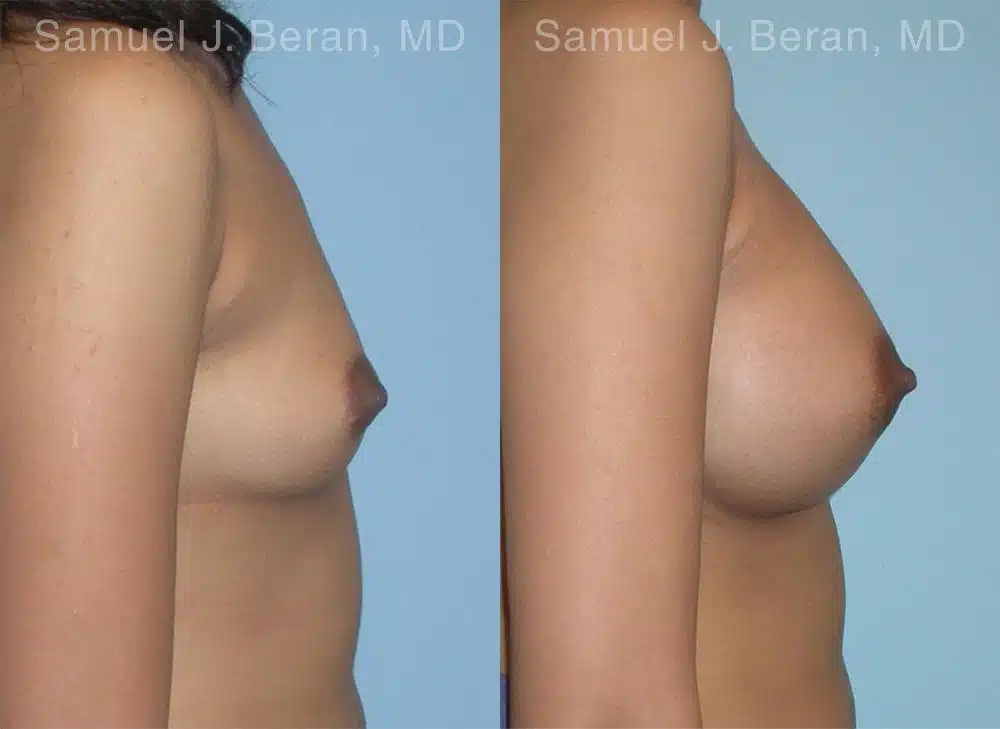 Breast Augmentation Before and After Photos in Newburgh, NY, Patient 12357