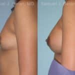 Breast Augmentation Before and After Photos in Newburgh, NY, Patient 12357