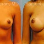 Breast Augmentation Before and After Photos in Newburgh, NY, Patient 12364