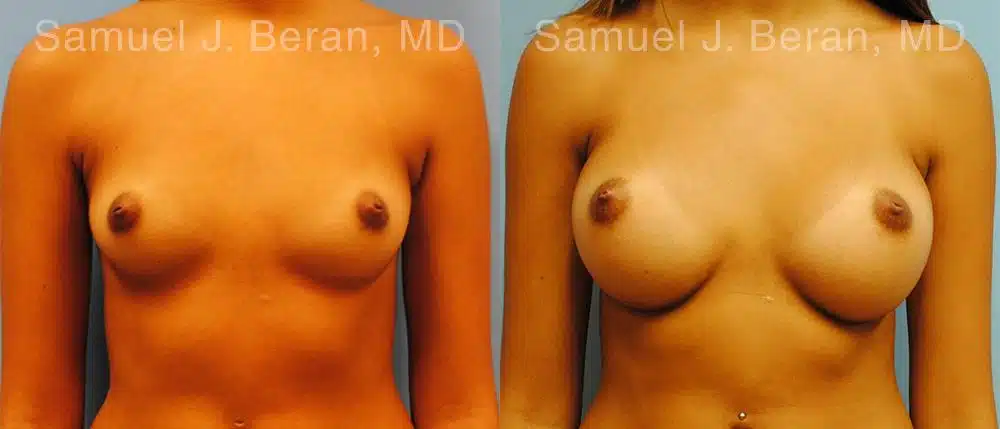 Breast Augmentation Before and After Photos in Newburgh, NY, Patient 12364