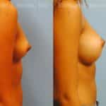 Breast Augmentation Before and After Photos in Newburgh, NY, Patient 12364