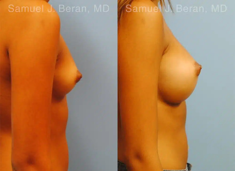 Breast Augmentation Before and After Photos in Newburgh, NY, Patient 12364