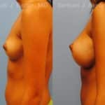 Breast Augmentation Before and After Photos in Newburgh, NY, Patient 12364