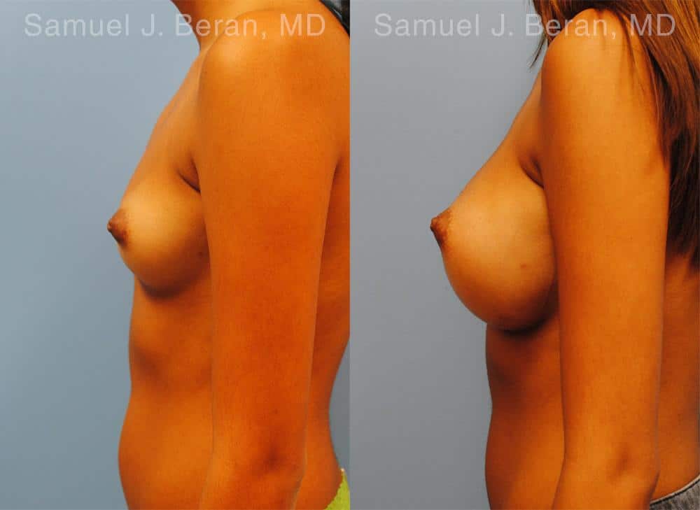 Breast Augmentation Before and After Photos in Newburgh, NY, Patient 12364