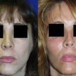 Cheek Augmentation Before and After Photos in Newburgh, NY, Patient 12371