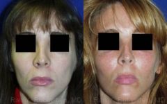 Cheek Augmentation Before and After Photos in Newburgh, NY, Patient 12371