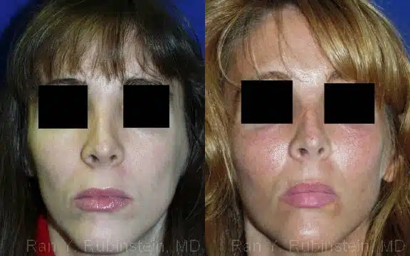 Cheek Augmentation Before and After Photos in Newburgh, NY, Patient 12371