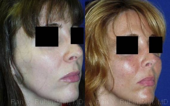 Cheek Augmentation Before and After Photos in Newburgh, NY, Patient 12371