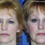 Brow Lift Before and After Photos in Newburgh, NY, Patient 12505