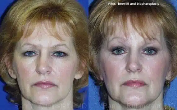 Brow Lift Before and After Photos in Newburgh, NY, Patient 12505