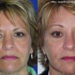 Brow Lift Before and After Photos in Newburgh, NY, Patient 12513