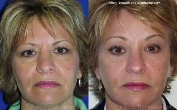 Brow Lift Before and After Photos in Newburgh, NY, Patient 12513