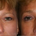 Brow Lift Before and After Photos in Newburgh, NY, Patient 12516