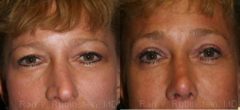 Brow Lift Before and After Photos in Newburgh, NY, Patient 12516